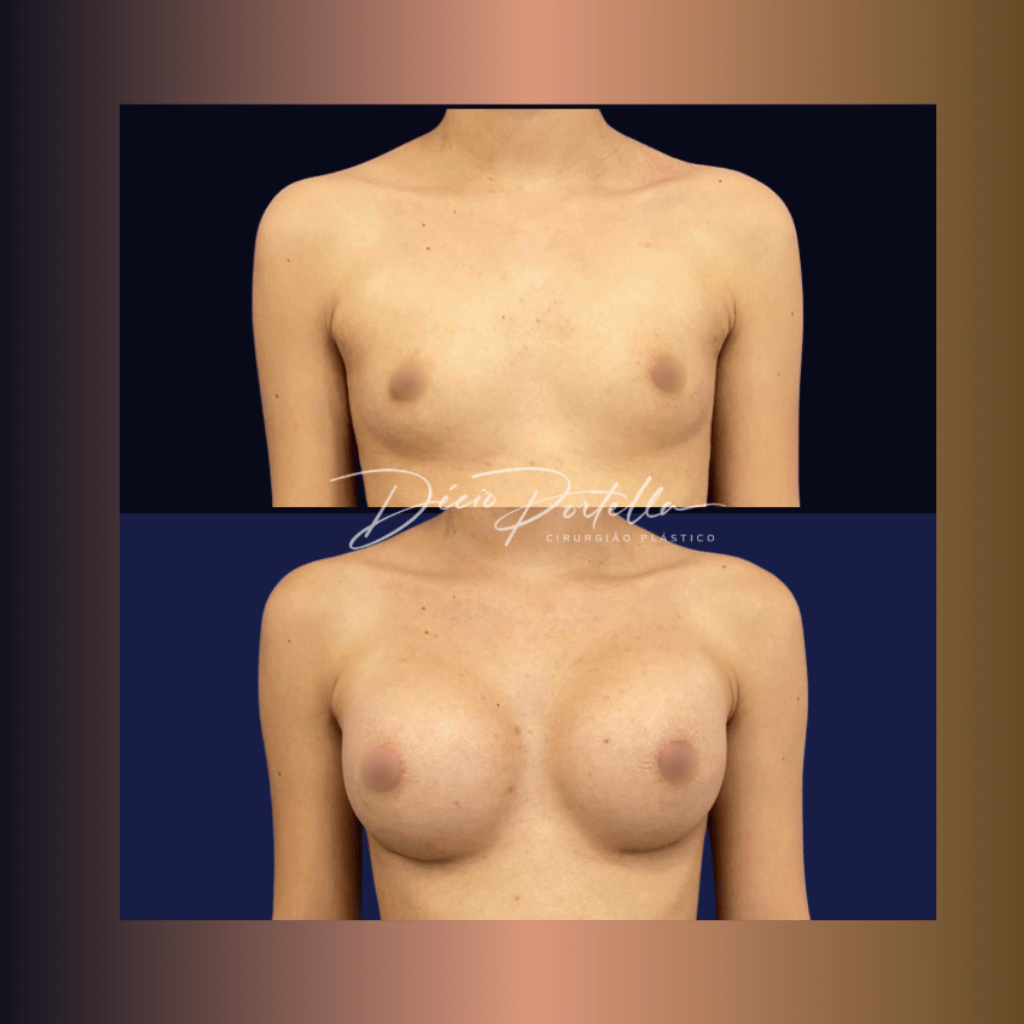 MAMOPLASTIA COM PRÓTESE (1)-min